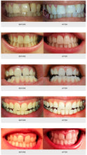 Load image into Gallery viewer, Dr. Aligner Power Whitening System - Deluxe at Home Kit
