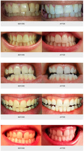 Dr. Aligner Power Whitening System - Deluxe at Home Kit